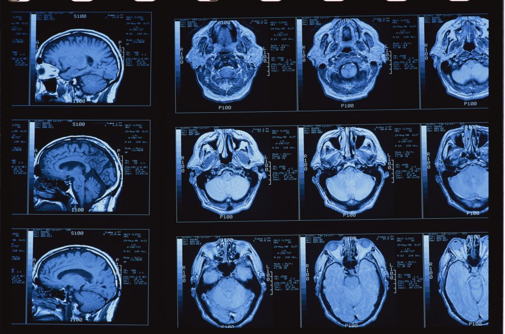 MRI Skull