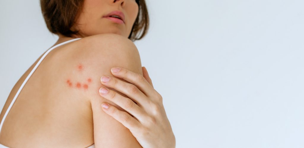 Woman bitten by bed bugs