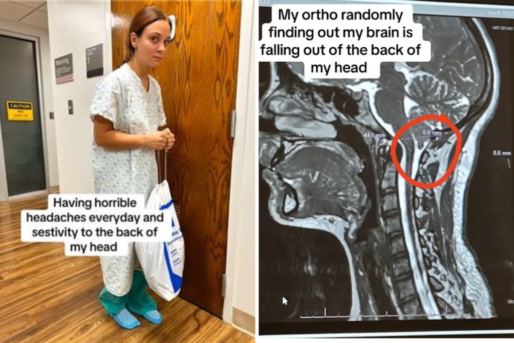 Teen suffers 48-day migraine, then discovers her brain is "falling out"